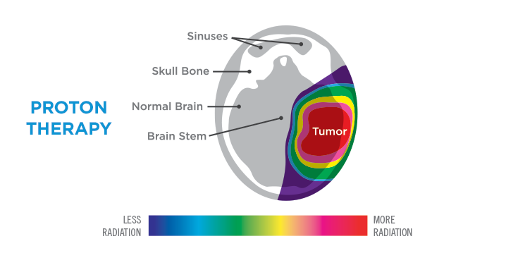 brain comparison protontherapy