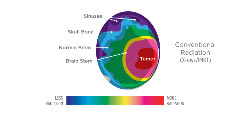 brain comparison traditional